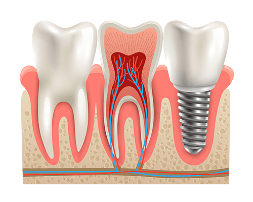 Implants dentaires : Dentiste sillingy, Geneve